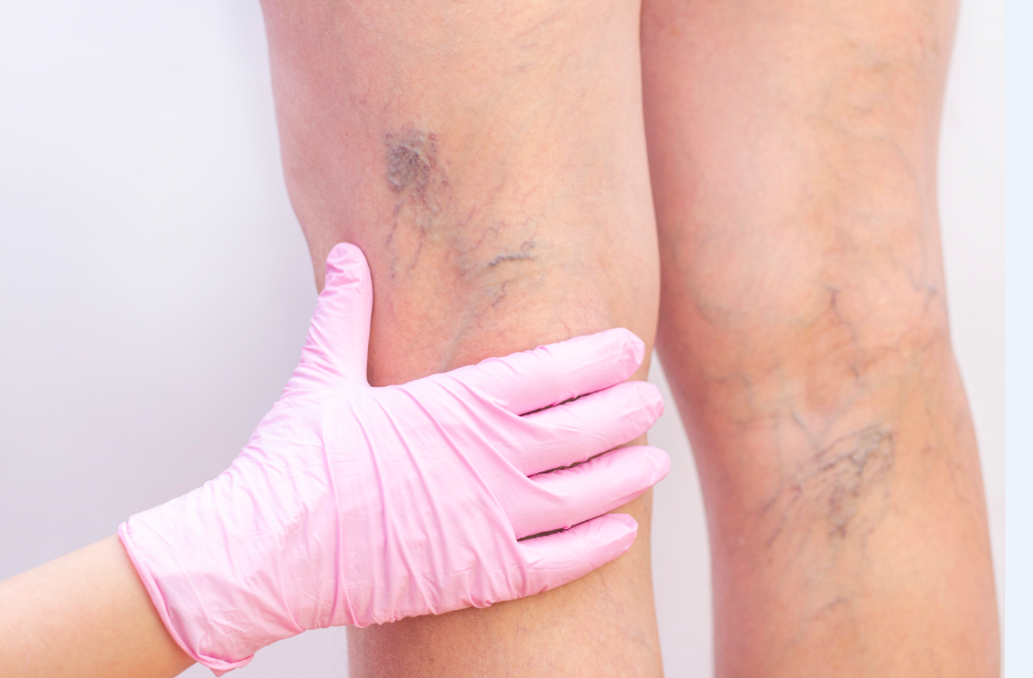 Aplicação de laser para secagem de vasinhos em ambiente clínico